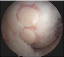 Chondral Defect Post Mosaicplasty